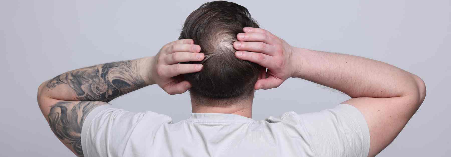 Best hair loss male pattern baldness treatments for you